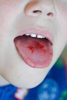 Close-up of lips, tongue, protrusion of blood. Child's bitten tongue. photo