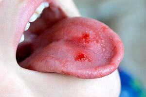 Close-up of lips, tongue, protrusion of blood. Child's bitten tongue. photo