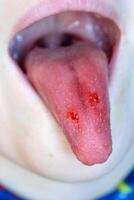 Close-up of lips, tongue, protrusion of blood. Child's bitten tongue. photo