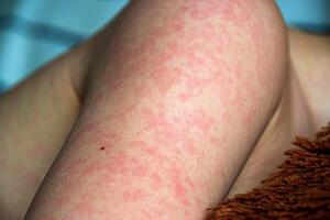 Viral disease. Measles rash on the body of the child. Allergy photo