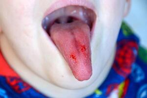 Close-up of lips, tongue, protrusion of blood. Child's bitten tongue. photo