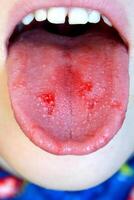 Close-up of lips, tongue, protrusion of blood. Child's bitten tongue. photo