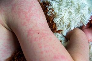 Viral disease. Measles rash on the body of the child. Allergy photo