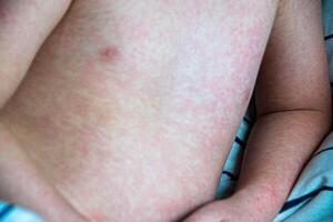 Viral disease. Measles rash on the body of the child. Allergy photo