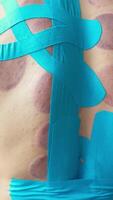 Male Athletic Back with Kinesio Tape After Sports Massage and Vacuum Therapy video