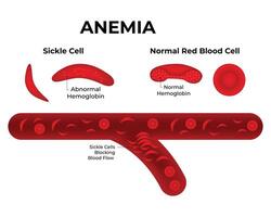 anemia Ciencias diseño ilustración diagrama vector