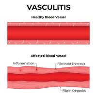 Vasculitis Science Design Illustration Diagram vector