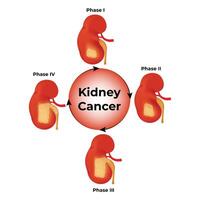 riñón cáncer Ciencias diseño ilustración diagrama vector