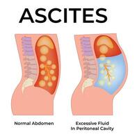 Ascites Science Design Illustration Diagram vector