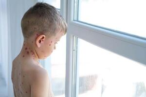 A sad boy with ulcers from chickenpox looks sadly out the window. A child treated with red medicine. Quarantine photo