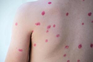 Treatment of ulcers from chickenpox, chickenpox with a healing cream on the skin of a child. Close-up of a child's back treated with red medicine. photo