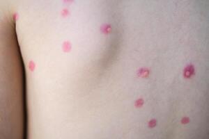 Treatment of ulcers from chickenpox, chickenpox with a healing cream on the skin of a child. Close-up of a child's back treated with red medicine. photo