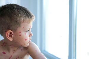un triste chico con úlceras desde varicela mira tristemente fuera el ventana. un niño tratado con rojo medicamento. cuarentena foto