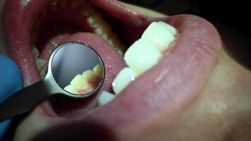 tandheelkundig zorg extreem dichtbij omhoog macro . tandarts traktatie geduldig tanden. orthodontist werken met microscoop en tandheelkundig spiegel. concept van professioneel tandheelkundig hygiëne. 4k 120 fps langzaam beweging rauw beeldmateriaal video