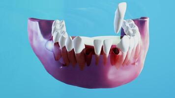 Ceramic dental implantation process. 3D render animation of stomatology dentist treatment, crown implant. Teeth treatment orthodontic surgery denture health and medicine. Oral hygiene video