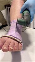 une homme avec une jeter sur le sien jambe coupes une bandage avec une broyeur. video