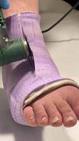 Mann verletzt seine Bein, seine Bein ist im ein gießen. Mann ist warten Chirurgie zu entfernen das Gips. video