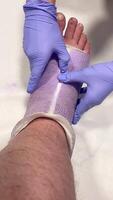 sjuksköterska tar bort ett ortopedisk kasta från en mannens ben. video