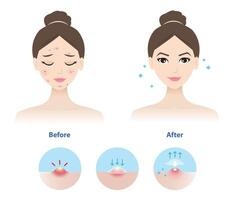 Comparison of woman face before and after use acne pimple patch for inflammatory acne illustration on white background. Icon set of direction for use acne patch absorbing pustule on skin face. vector