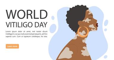 Afro-american woman illustration with vitiligo banner. World Vitiligo Day. vector