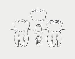 dientes implante ilustración dibujo en lineal estilo en blanco antecedentes vector