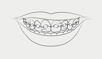 Smile with teeth braces in linear style drawing on white background vector