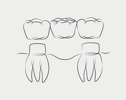 Teeth with crown bridge illustration drawing in linear style on white background vector