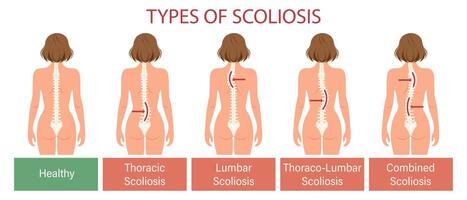 Types of scoliosis, spinal disease. Infographics banner with human scoliosis spine. Healthcare and medicine. Illustration, poster vector