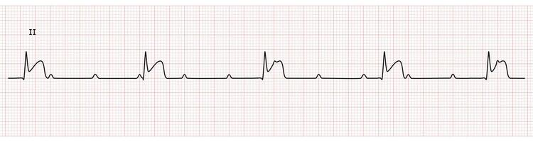 EKG Monitor in lead II Showing Complete heart block with STEMI at Inferior Wall vector