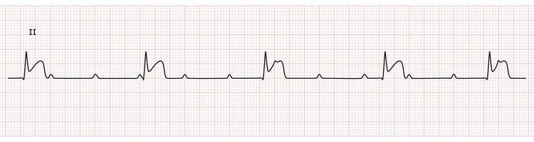 EKG Monitor in lead II Showing Complete heart block with STEMI at Inferior Wall vector