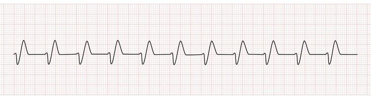 EKG Monitor Showing Wide QRS Complex From Hyperkalemia vector