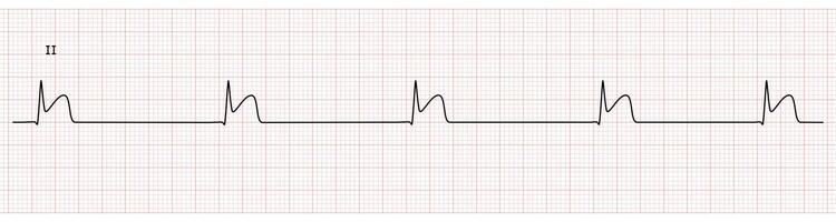 EKG Monitor in lead II Showing junctional Bradycardia with STEMI at Inferior Wall vector