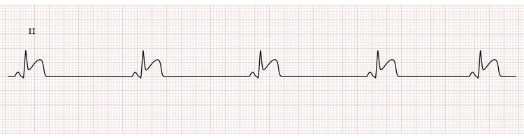 EKG Monitor in lead II Showing Sinus Bradycardia with STEMI at Inferior Wall vector