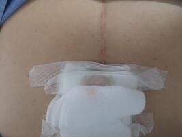 back surgery wound Gauze to cover the wound photo