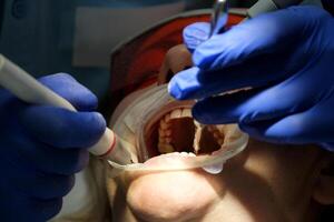 médico escaneos el del paciente dientes en el clínica. el dentista sostiene en su mano un manual 3d escáner para el mandíbula y boca. dental salud. crea un 3d modelo de dientes y cena en un médico monitor. foto