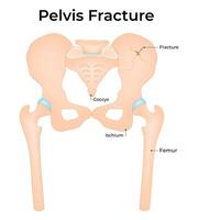 Pelvis Fracture Science Design Illustration Diagram vector