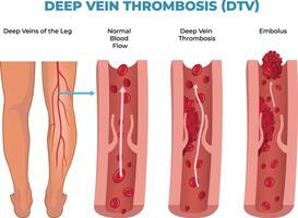 illustration of deep vein thrombosis diagram, DVT vector