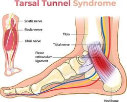 illustration of tarsal tunnel syndrome diagram vector