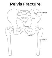 Pelvis Fracture Science Design Illustration Diagram vector