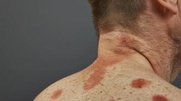 An image of a mans skin after the cups have been removed revealing red circular marks. These marks are caused by the suction and are a normal part of the cupping therapy process photo