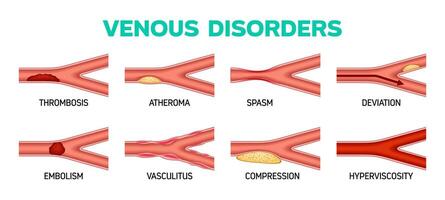 vena enfermedad, venoso trastornos infografia vector