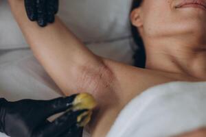Sugaring. epilation with liquate sugar at armpit. photo