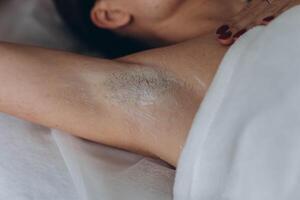 Sugaring. epilation with liquate sugar at armpit. photo