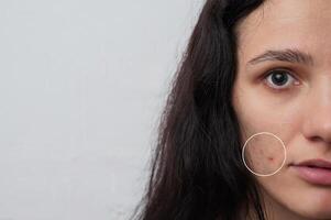 Close-up of a young girl with skin problems. Pimples, acne, pores, scars. Natural skin with and without filters. A place for your text. photo