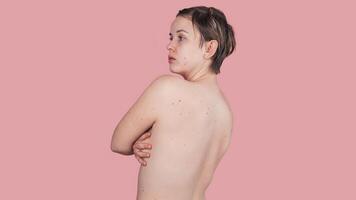 A woman's body with numerous moles. Prevention of skin Cancer. The panorama. A place for the text. photo
