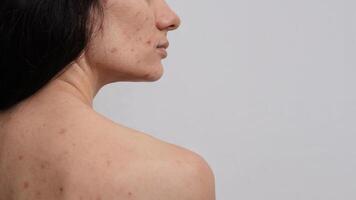 A close-up of a panoramic image of the skin of a woman with acne and other dermatological problems. A place for your text. photo