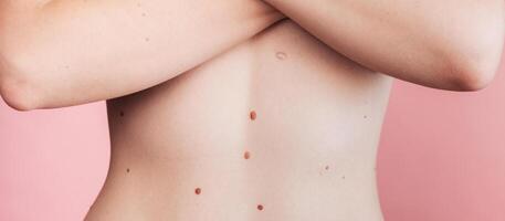 A woman's belly with numerous moles. The effect of the sun on the skin. Skin cancer. The panorama. photo