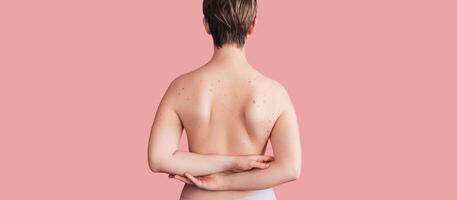 There are many moles on the back of a young girl. The effect of the sun on the skin. The panorama. A place for the text. photo
