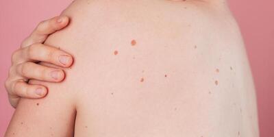 Close-up of a young woman's back with moles on the background. Without filters. Panoramic banner. photo