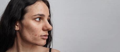Close-up of a young woman with acne on her face and skin problems. A panoramic shot on the banner. a place for your text photo